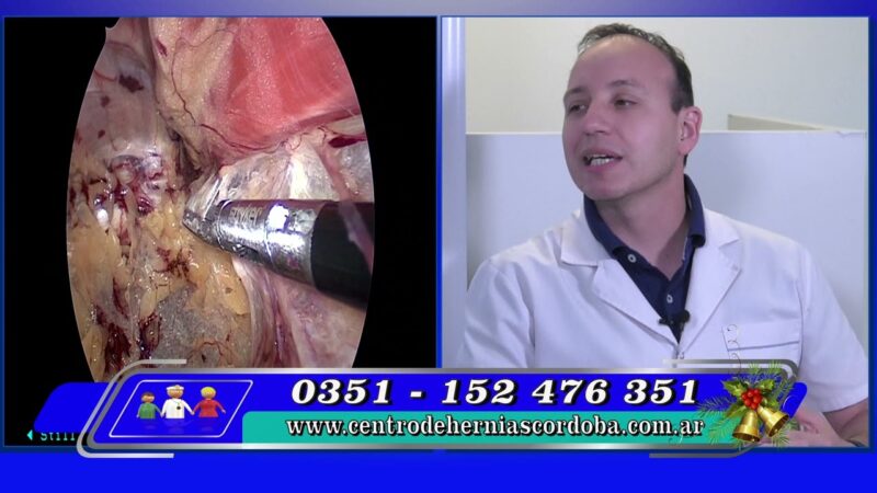 Novedosa técnica para abordar las hernias