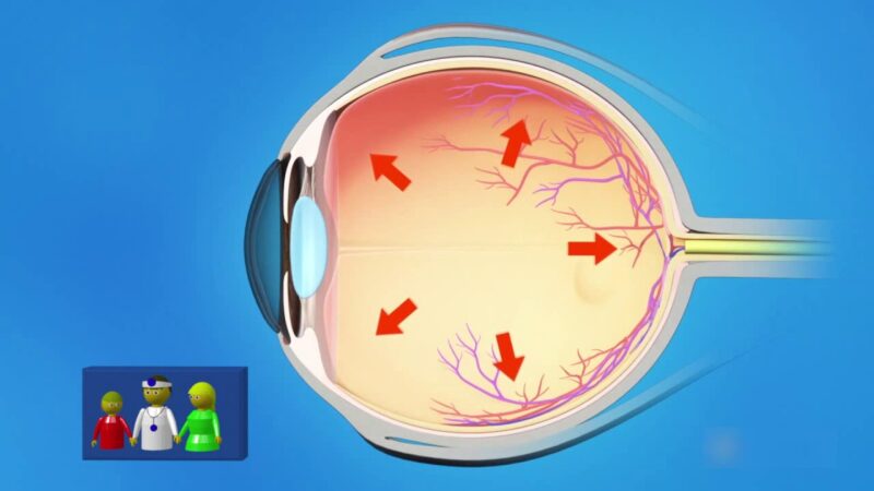El glaucoma sigue siendo principal causa de ceguera