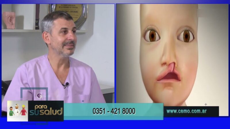 Labio leporino ¿por qué se produce?