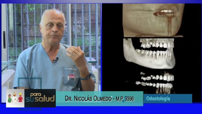 Como solucionar la falta de hueso para la colocación de un implante dental