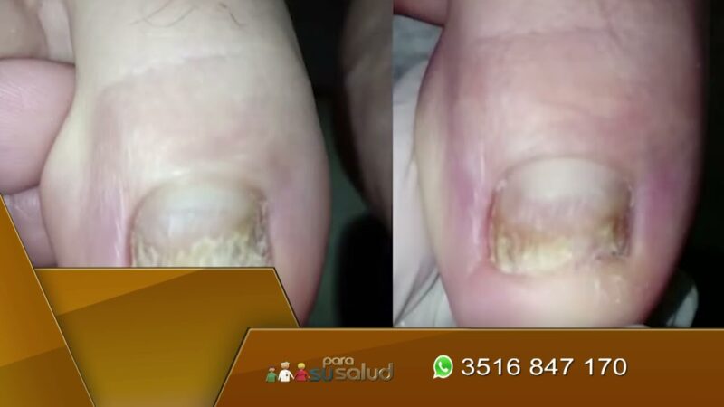 Tratamiento laser para los hongos de las uñas