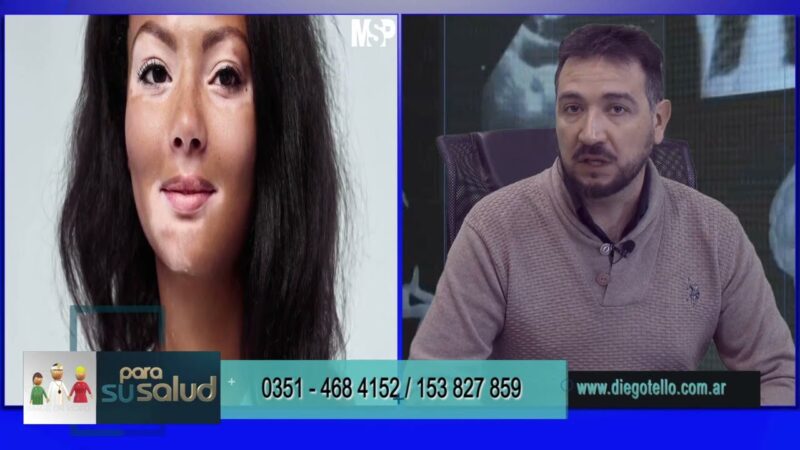 Hay alternativas para tratar el vitiligo