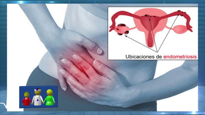 Dolor por endometriosis