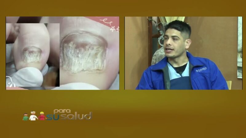Hongos en las uñas del pie, ¿Sólo en el dedo gordo?