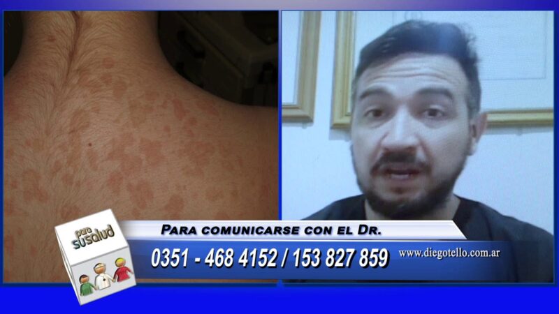 Acantosis nigricans o pitiriasis versicolor Â¿tienen tratamiento?