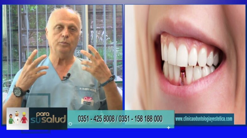 Cuantos implantes debo colocarme para recuperar mi dentadura