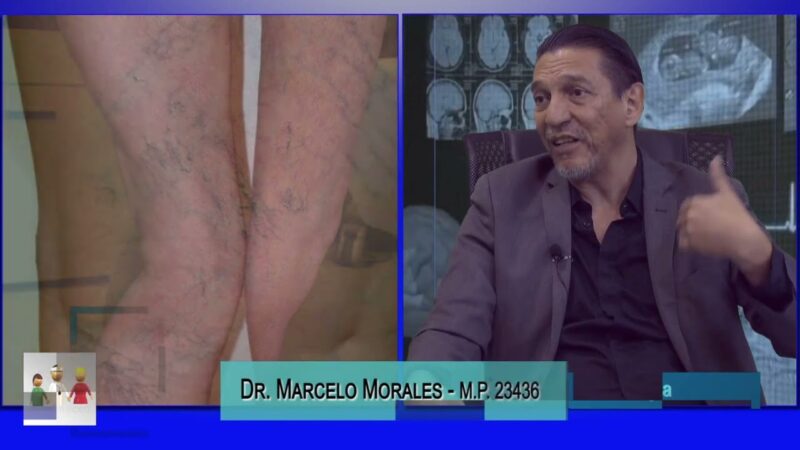 Me aparecieron varices de golpe ¿por qué?