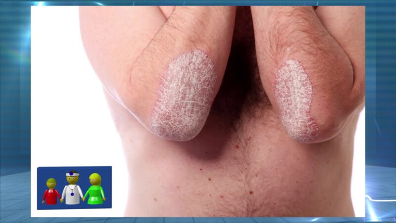 Psoriasis