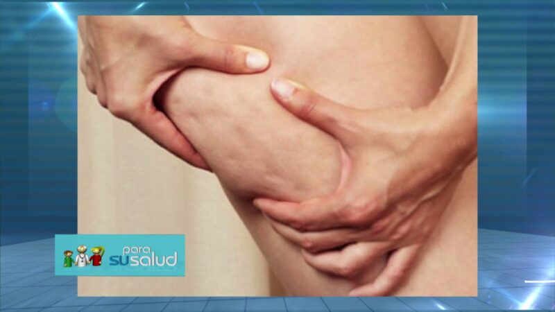 Celulitis en la piel