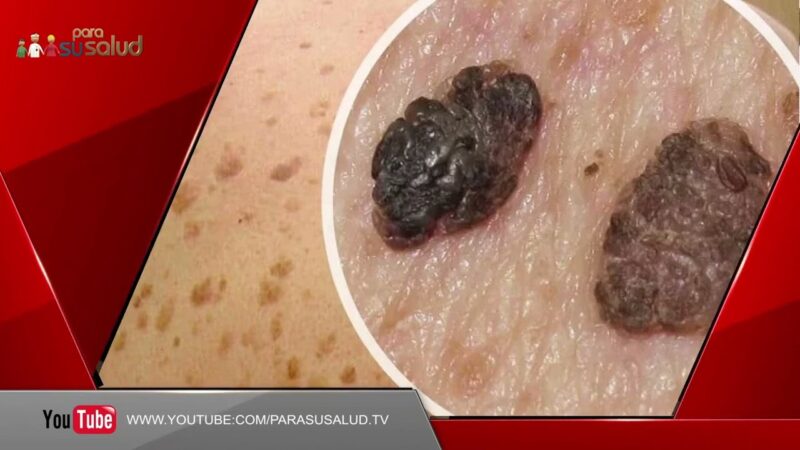 La verruga ¿es un tipo de lunar?
