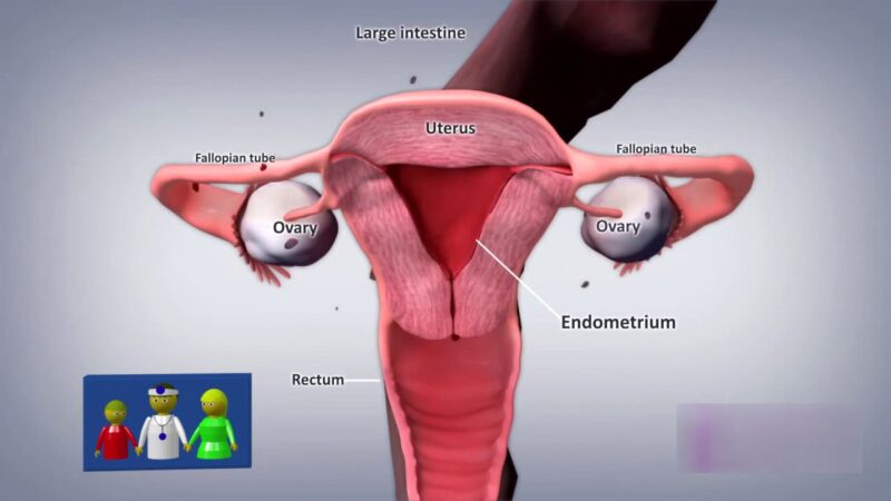 La endometriosis tiene soluciÃ³n