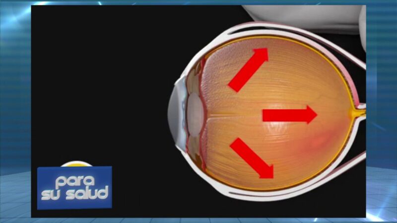 Se puede tener glaucoma con presiÃ³n normal