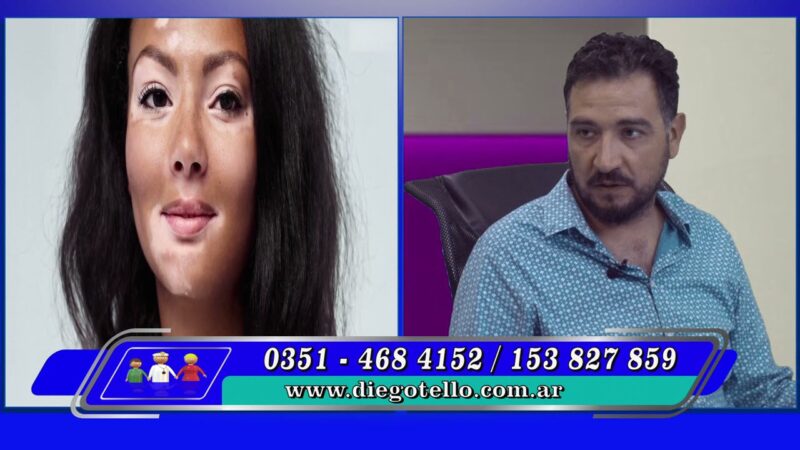 Vitiligo