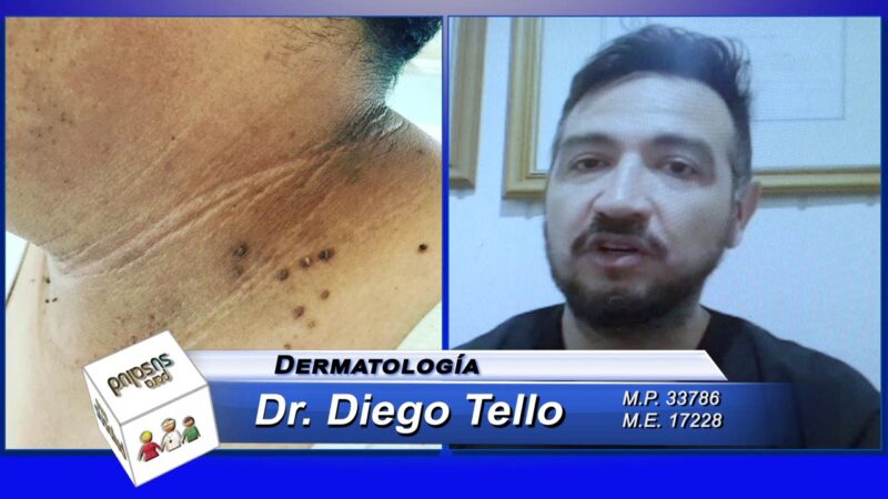 Verrugas y zonas amarronadas en la piel Â¿es por diabetes?