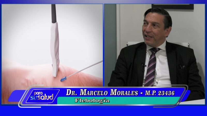 Cuál es el mejor tratamiento para mis varices