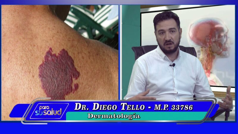 MalformaciÃ³n vascular Â¿es posible tratarla con cirugÃ­a?