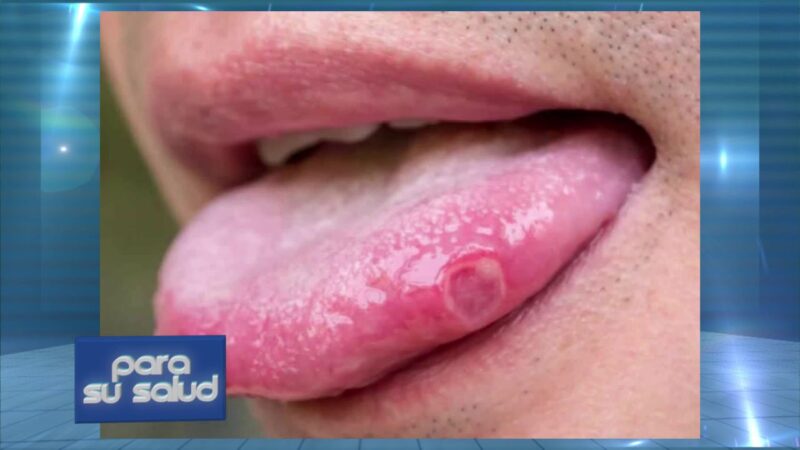 HPV en Otorrinolaringologia