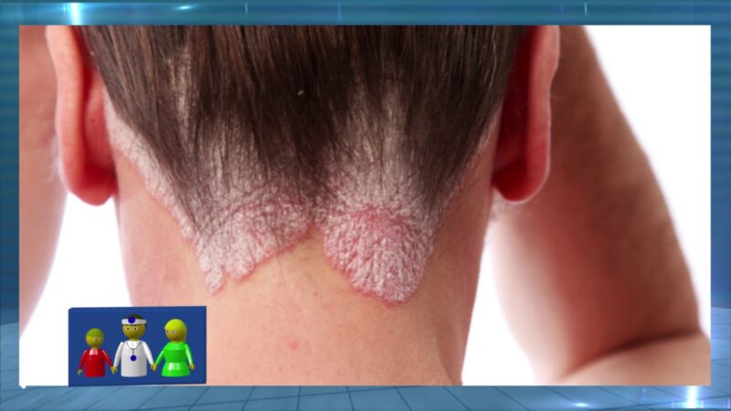 La psoriasis Â¿enfermedad autoinmune o psicolÃ³gica?