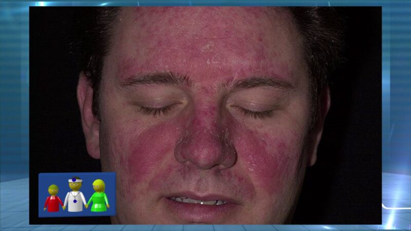 La psoriasis Â¿se manifiesta en el rostro?