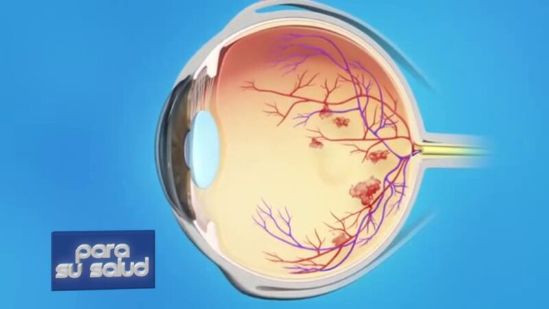 DegeneraciÃ³n macular relacionada con la edad