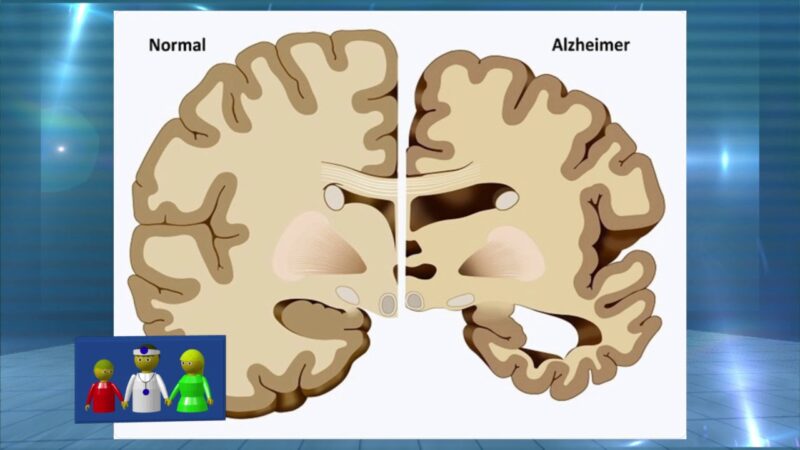 La importancia del chequeo cardio cerebro vascular
