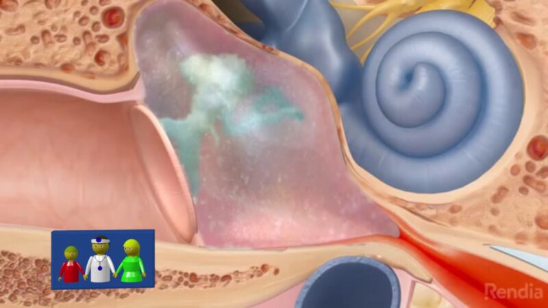 Diferencia entre otitis externa, media e interna