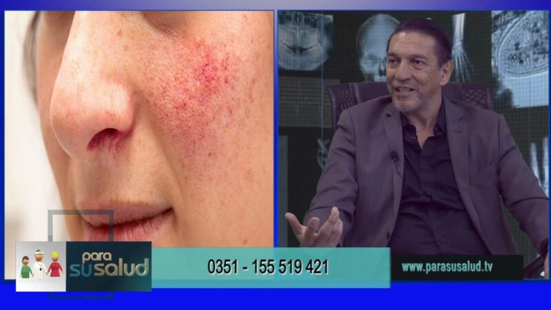 Varices en el rostro