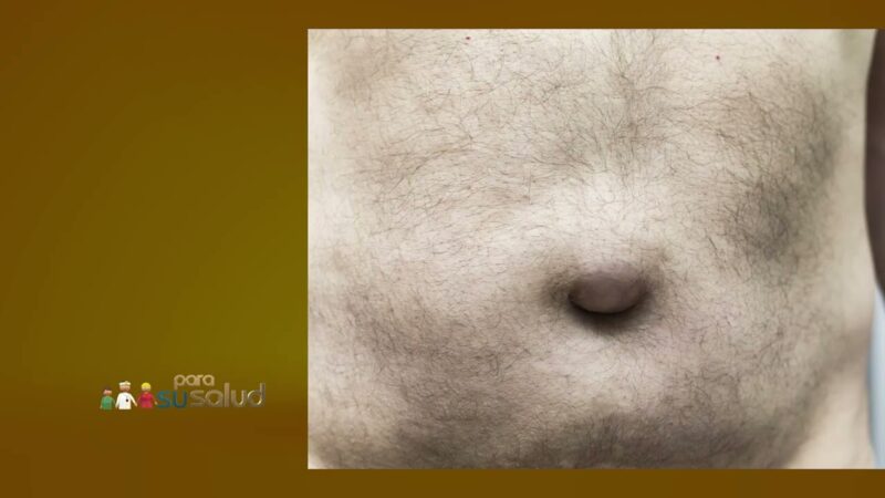 Bulto en abdomen ¿Es siempre una hernia?