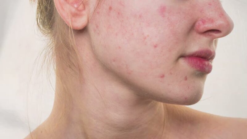 Empecé el gimnasio y me apareció acné ¿Por qué?