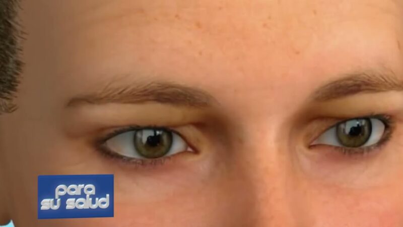 Ptosis palpebral