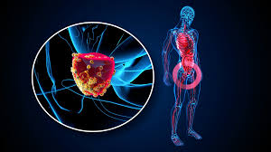 Cáncer de próstata: más de 13.000 casos al año y 70% de diagnósticos tardíos refuerzan la importancia del PSA