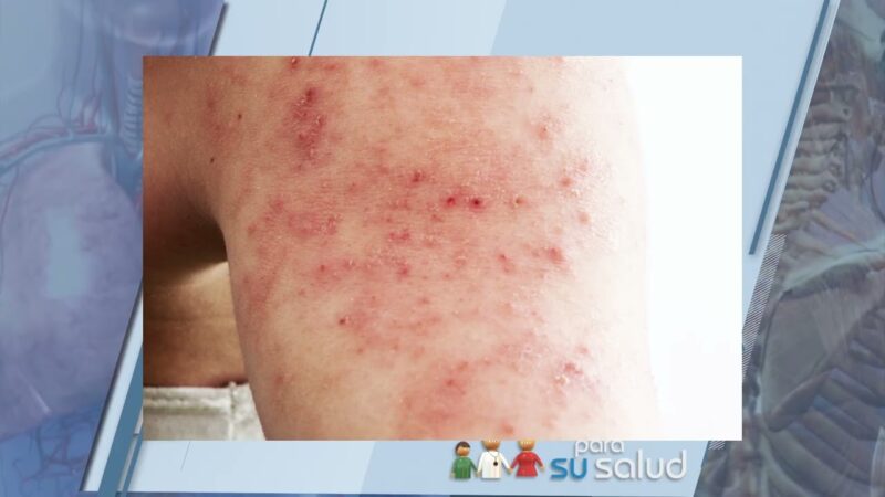 Novedades para el tratamiento de la psoriasis